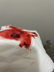 5 weeks past conception (7weeks nhs) early miscarriage *[pic included]