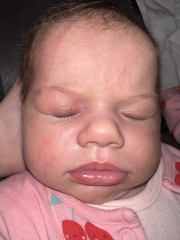 Rash/spots only on babies head and face
