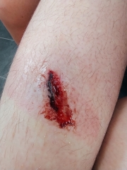 Any wound experts out there? (includes pic - warning!)
