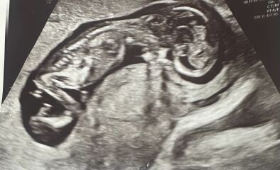 12 weeks scan