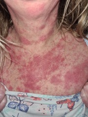 Burning and painful skin.
