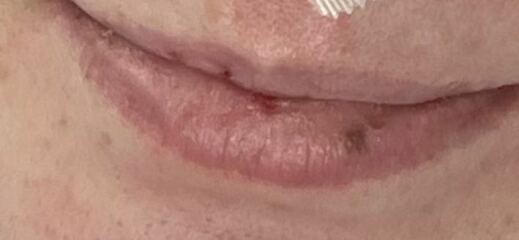 How to heal bruise on lip that’s been there years? Pics