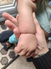 What is this rash please?