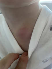 Does this cyst look infected? Pics attached