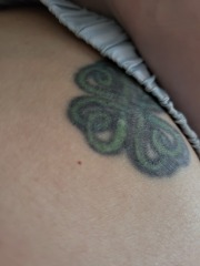 Petechiae or cherry angioma? Talk me down