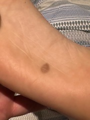 Moles / mark on sole of foot