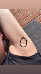 Worried sick about underarm lump/lymph node