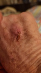 Do I need an antibiotic?