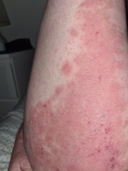 Burning and painful skin.
