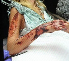 Do I need an antibiotic?