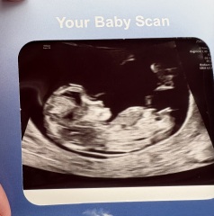 12 week scan🤍 What do we think 🤍