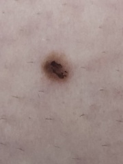 Is this mole a laser burn from hair removal or worse?!