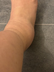 Foot bruising and swelling after 3.5 weeks