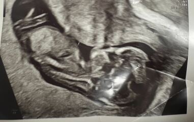 12 weeks scan