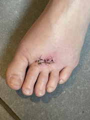 Infected stitches?