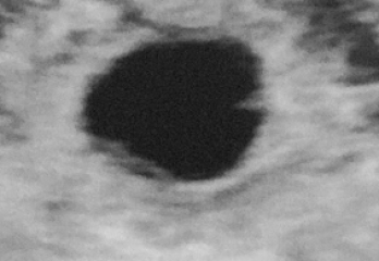Scan confusion! 5 weeks scan