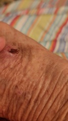 Do I need an antibiotic?