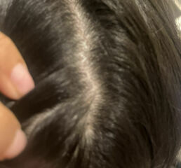 Black round hard balls found on daughters  scalp