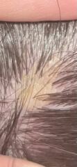 Scalp growth (pics included)