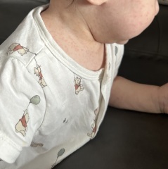 Baby rash