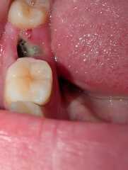 Tooth extraction healing
