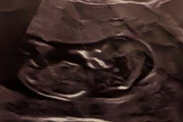 Can you guess sex from my crumpled 12wk scan
