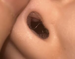 Nasal Polyps - 3 year old?
