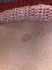 What the heck is this circular rash type thing on my back?