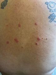Insect Bite Diagnosis help!