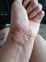 Contact Dermatitis? Please help!