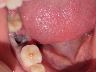Tooth extraction healing