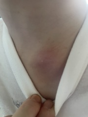 Does this cyst look infected? Pics attached