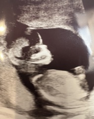 what should a normal PAPP-A and hCG result be at 12 weeks - v confused