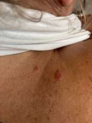 Insect Bite Diagnosis help!