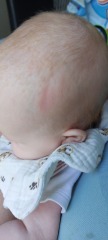 Baby leant on something and left a slight indent in head