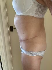 Anyone here had a tummy tuck after success on MJ ?