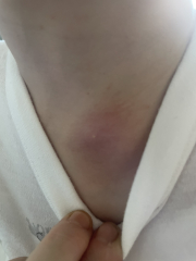 Does this cyst look infected? Pics attached