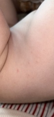 Is this chickenpox?