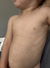rash appeared 4 days ago on my son