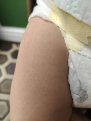 What is this rash please?