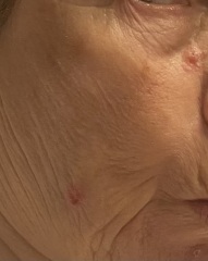 What is this sore on my Mum's face?