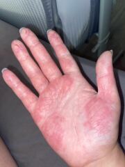 Sore hands