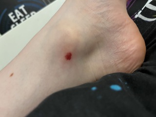 Infected insect bite?