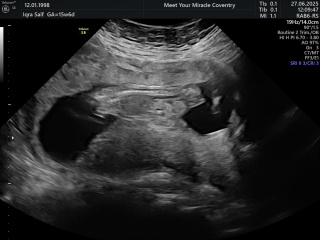 Baby gender 16 weeks scan