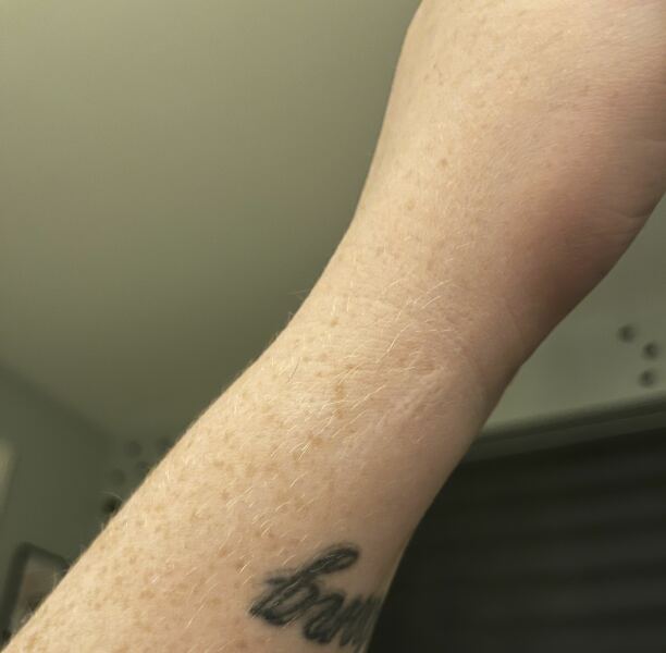What's been your worst food injury?