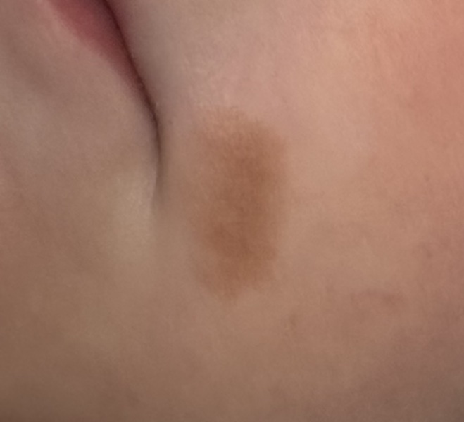 Mark on toddlers face