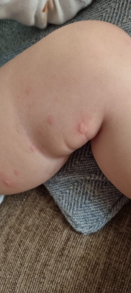 Raised bumpy rash on infant