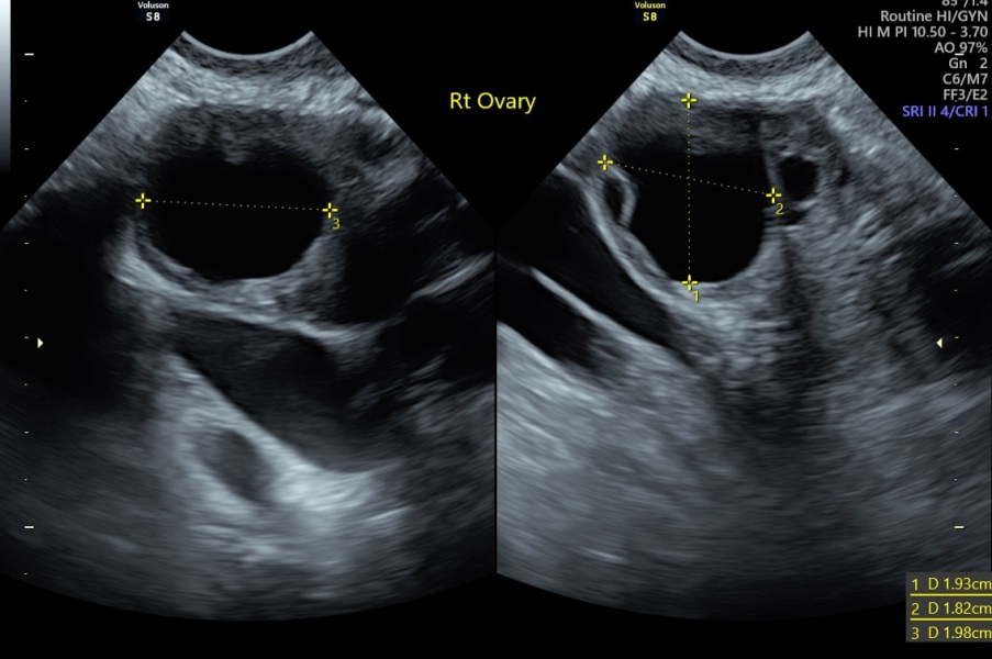 Pelvic Pain - Unknown and Worried