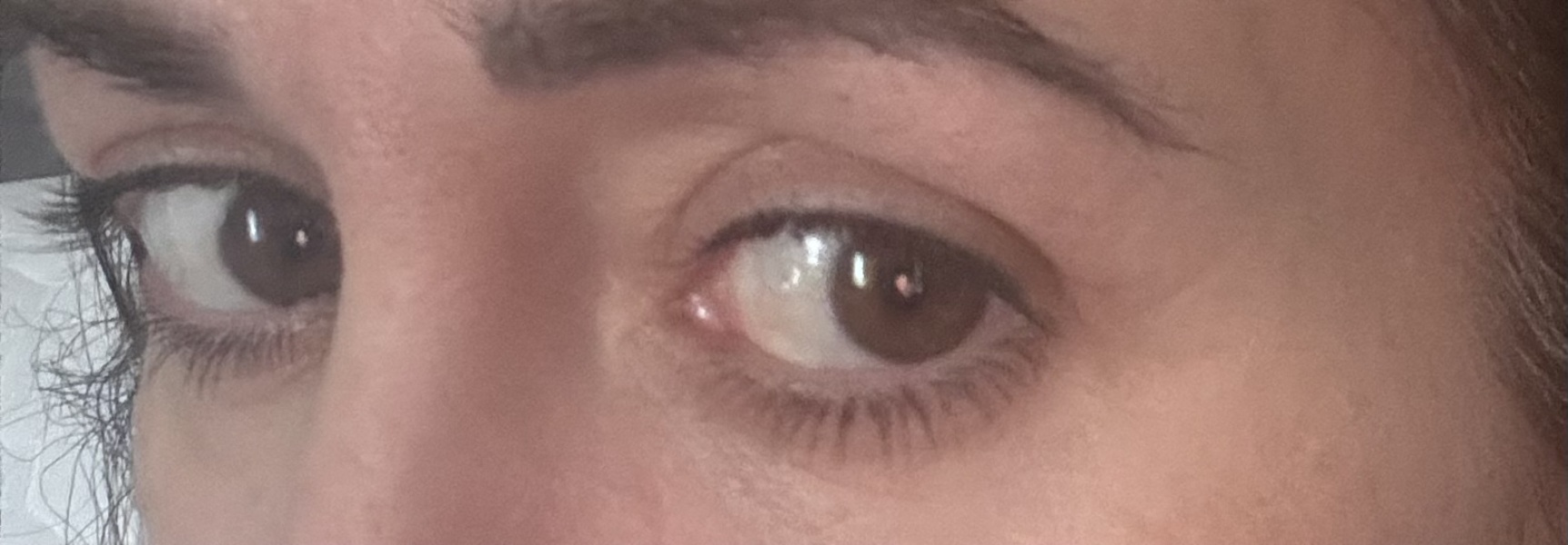 Upper bleph gone wrong ????