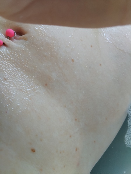 New moles/freckles in excess?